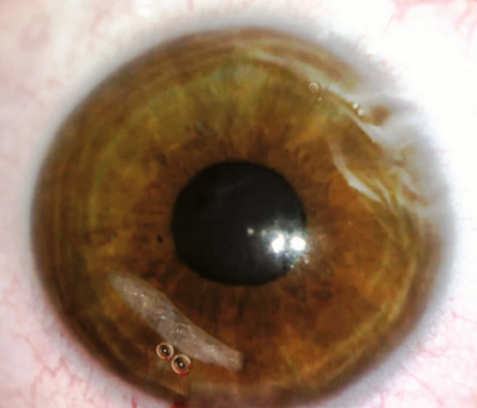 Foto av et øye med brun iris, nederst til venstre i iris er det en gjennomsiktig hvit larve av reinens hudbrems