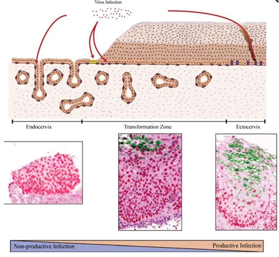 Celletyper mottagelige for HPV infeksjon i cervix, og type infeksjon forårsaket av HPV. Regulering av virusets genuttrykk endres med egenskapene til de basale cellene og med hvilke område i cervix som smittes. Modifisert fra J. Viruses (4)